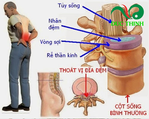 cỏ xước chữa thoát vị đĩa đệm