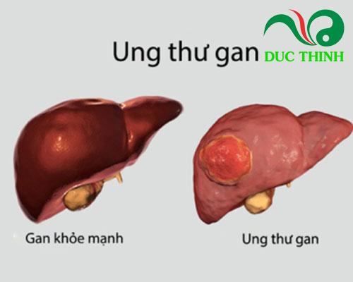 2 bài thuốc nam điều trị ung thư giai đoạn cuối