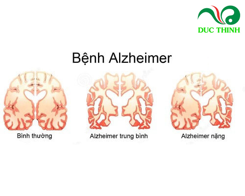 Cách sử dụng cây thông đất chữa teo não