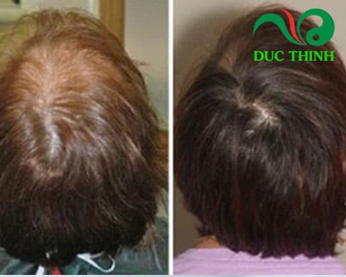 hieu_qua_sau_khi_dung_cao_ha_thu_o