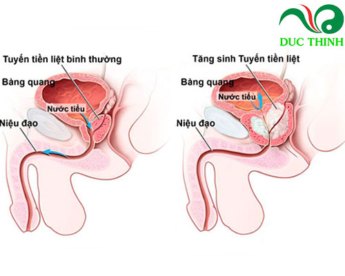 cây bồ quân hỗ trợ điều trị u xơ tuyến tiền liệt