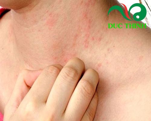 Cây cỏ sữa chữa mẩn ngứa