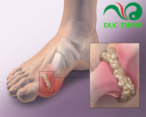 Cây tơ trong điều trị bệnh gout