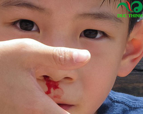 Cây đại kế hỗ trợ điều trị chảy máu cam