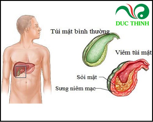 Công dụng của sỏi mật trái sung