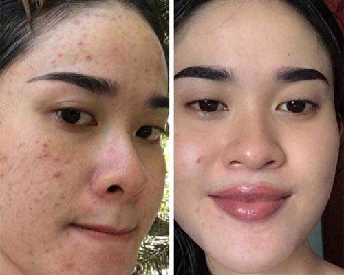 trước và sau khi sử dụng mộc thảo tây