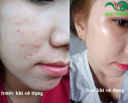 thuốc bắc trị mụn hiệu quả
