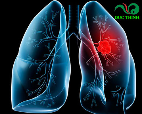 Lá chùm ngây có thể tiêu diệt tế bào ung thư