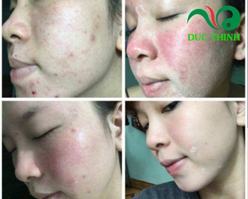 mua thuốc trị mụn gia truyền ở đâu