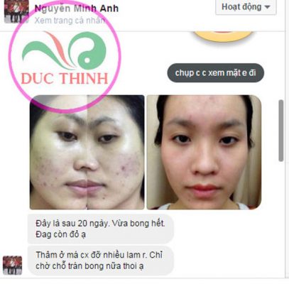 phản hồi sau khi dùng thuốc nam trị mụn