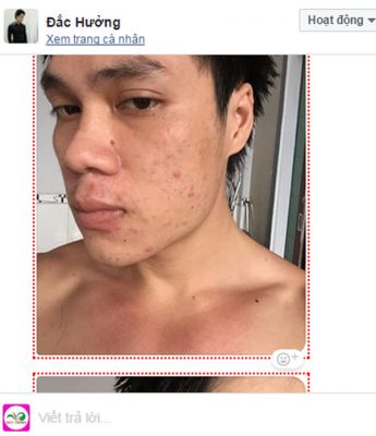 phản hồi sau khi dùng thuốc nam trị mụn