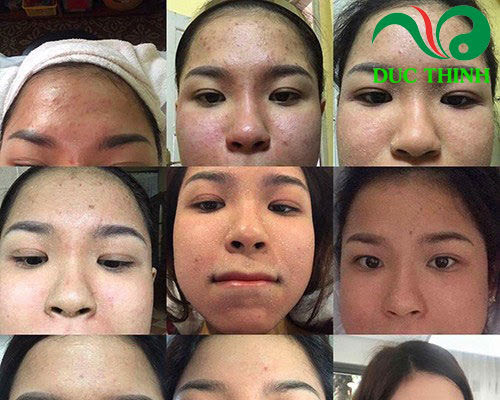 quá trình điều trị bằng đông y trị mụn gia truyền