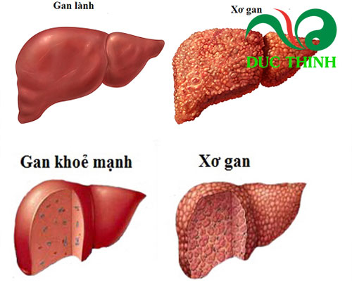 Rễ cà gai leo chữa xơ gan 