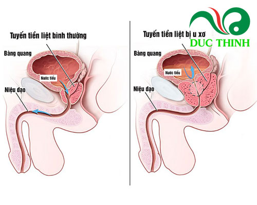 Rễ cây hồng quân điều trị u xơ tuyến tiền liệt