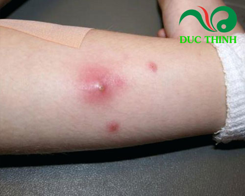 ha_kho_thao_ho_tro_dieu_tri_benh_ve_da