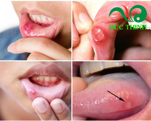 Tinh bột nghệ trị nhiệt miệng