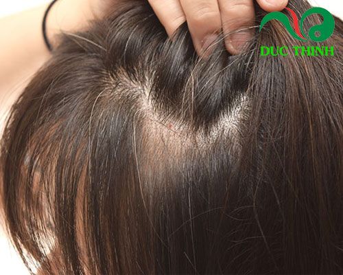 tinh chất hà thủ ô trị tóc bạc sớm