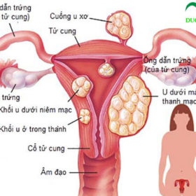 Cây trinh nữ hoàng cung trị bệnh gì?