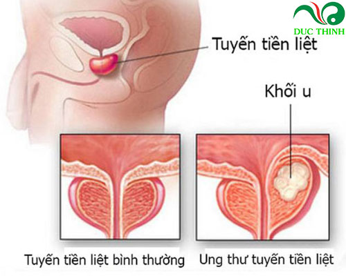 cây náng hoa trắng hỗ trợ điều trị u xơ tuyến tiền liệt