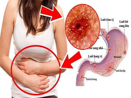 chè dây chữa bệnh viêm loét bao tử