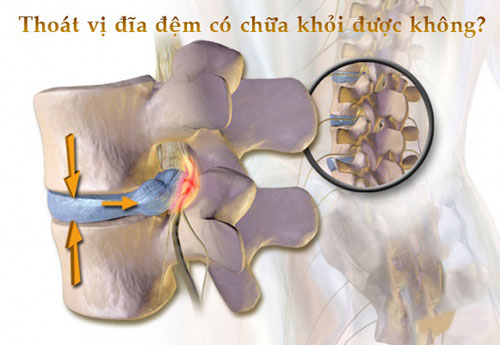 Thoát Vị Đĩa Đệm Có Chữa Được Không