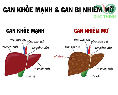 Gan Nhiễm Mỡ