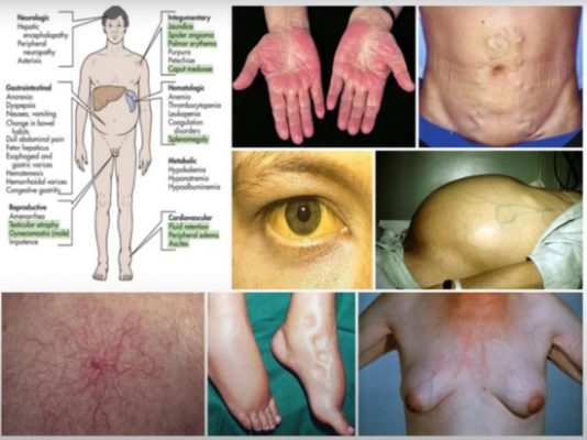 Cây an xoa chữa xơ gan hiệu quả