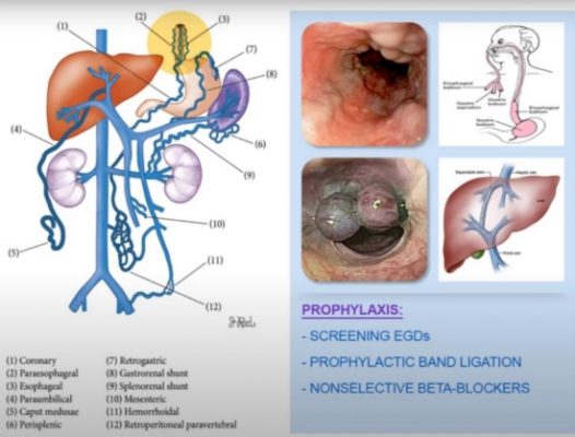 Cách dùng cây an xoa chữa xơ gan