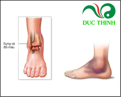 Cây bìm bịp trị bong gân