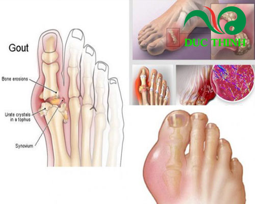Cây nở ngày đất trị bệnh gout