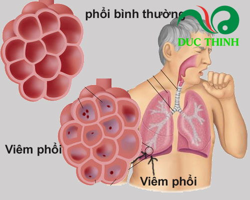 Cây lưỡi rắn chữa viêm phổi