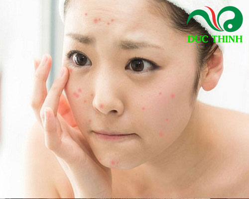 Kim ngân hoa trị mụn có hiệu quả không?