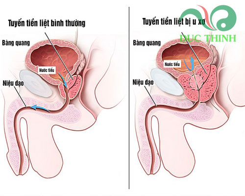 Công dụng của rễ cây bồ quân ngâm rượu